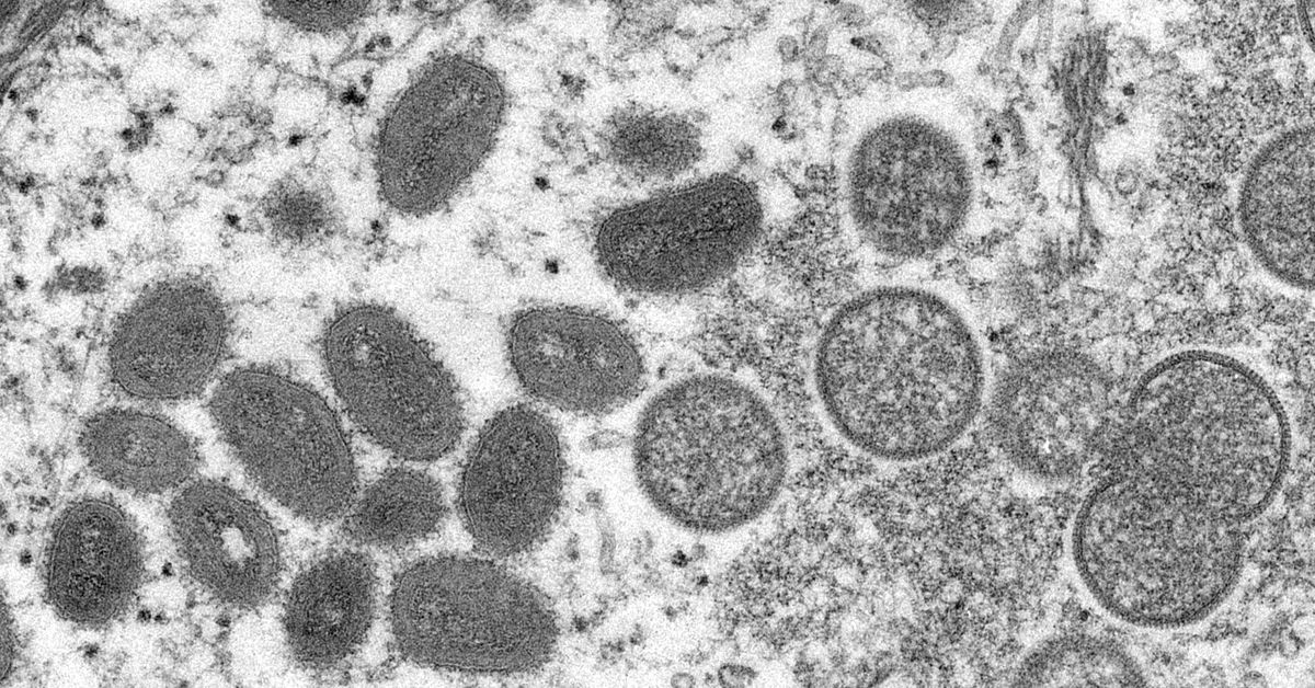 Le virus de la variole se propage dans le monde