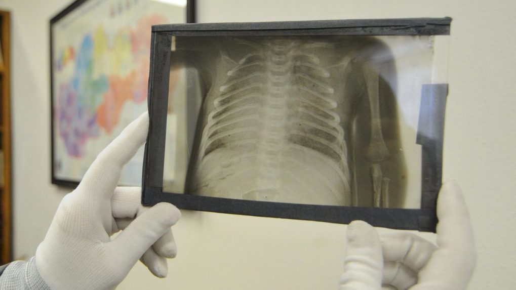 Na snímke pracovníčka Štátneho archívu v Levoči ukazuje jednu z prvých röntgenových snímok urobených na Spiši doktorom Vojtechom Alexandrom v Kežmarku koncom 19. storočia.