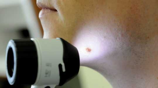 Dermatologické vyšetrenie znamienka dermatoskopom.