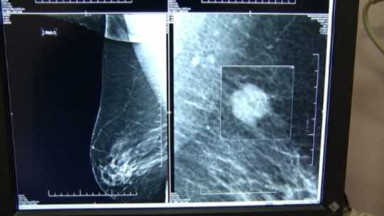 Na ilustračnej snímke mamografická snímka prsníka s rakovinou.