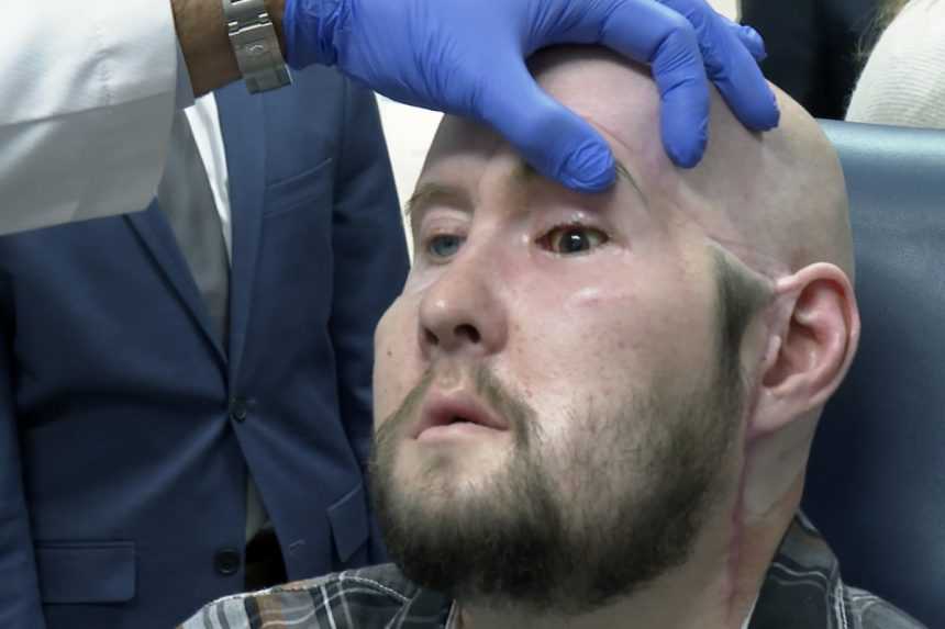 Prelomová operácia: Americkí chirurgovia prvýkrát transplantovali celé oko aj časť tváre