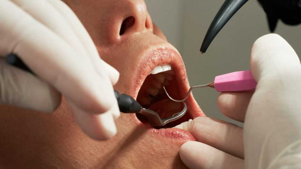 Zubné benefity v zdravotných poisťovniach končia. Podľa ministerstva zdravotníctva svoj účel splnili