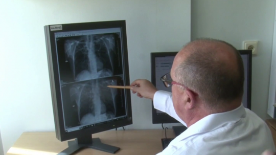 Lekár sa v ordinácii na röntgenový snímok pľúc.